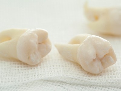 智齒疼了，這牙非拔不可嗎？