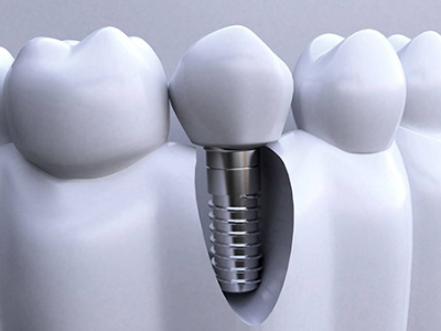 承德種植牙價格表，2024種植牙多少錢一顆呢?