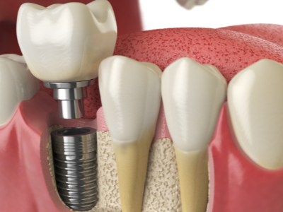 選擇種植牙后要做哪些日常維護(hù)？