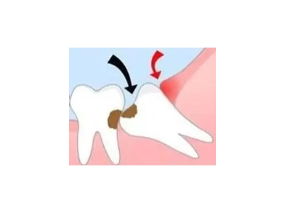 吃完飯后老塞牙？別大意！這可能是你的牙齒在報(bào)警