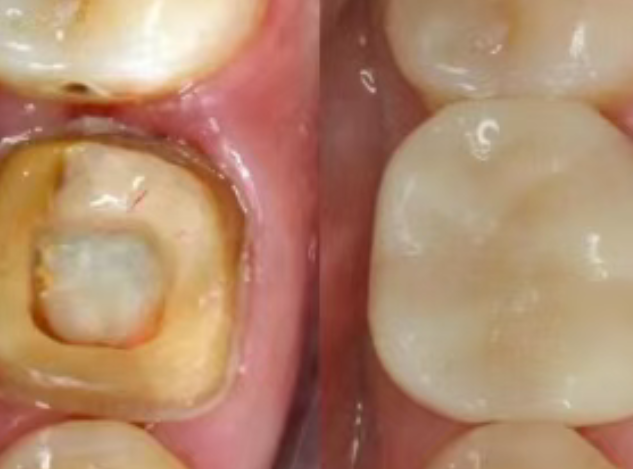 根管治療（抽神經(jīng)）后，為什么一定要做牙冠？