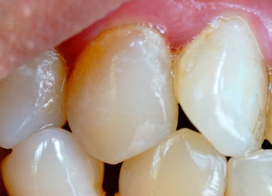 牙齒表面的牙釉質(zhì)掉了還可以修復(fù)嗎？