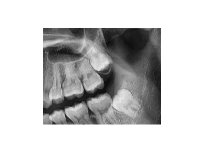 既然「智齒」不宜久留，為什么不能一次性拔掉？