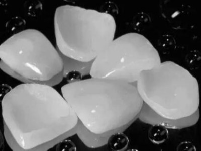 承德牙科做貼面多少錢(qián)一顆