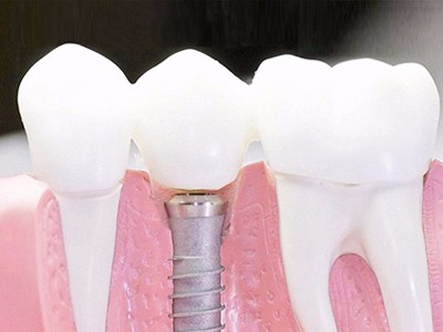 在承德口腔種植齒需要多少錢？惟德口腔一一為您道來