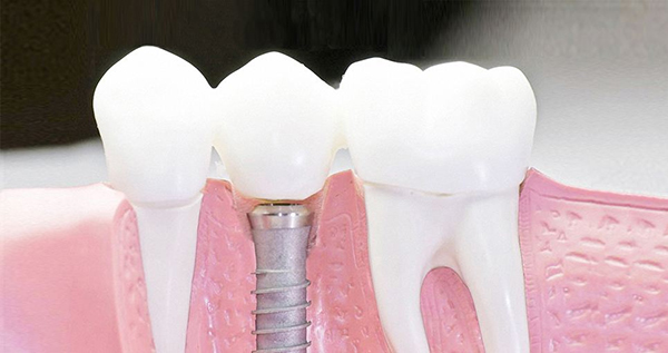 在承德口腔種植牙齒需要多少錢？惟德口腔一一為您道來